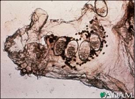 Image of scabies mite and eggs