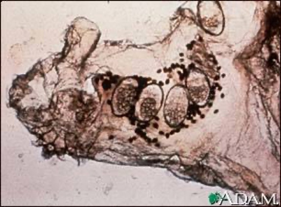 Image of scabies mite and eggs